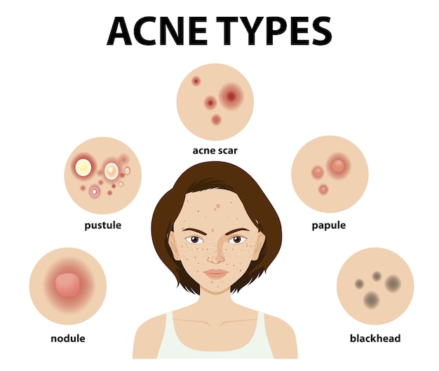 Healing from Within: Homeopathy’s Impact on Acne