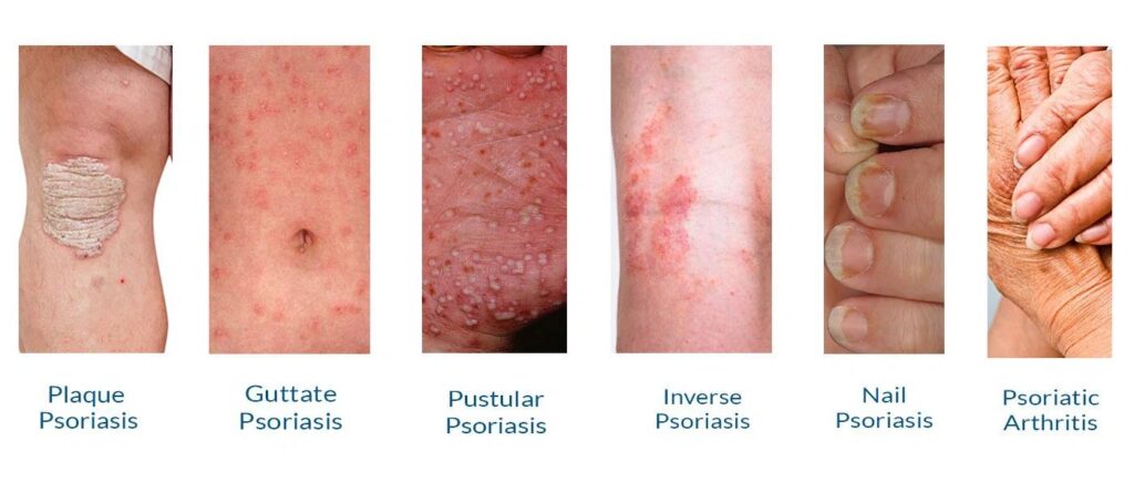 Illustration depicting different types of psoriasis on human skin.