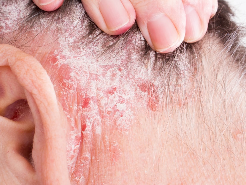 A person receiving scalp psoriasis treatment